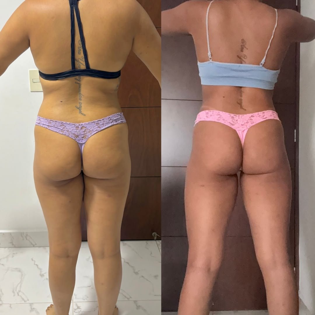 Transformación de glúteo de una alumna, antes y después