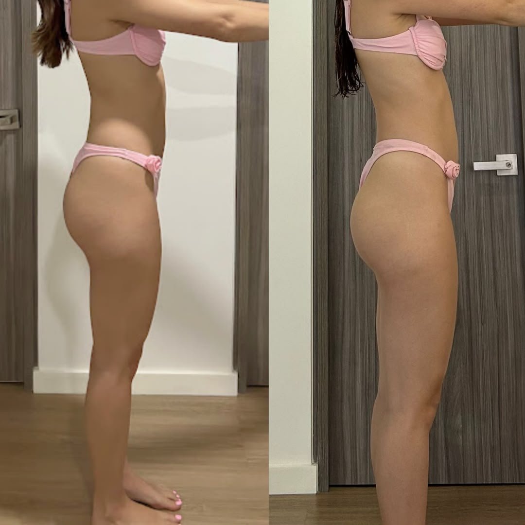 Transformación de glúteo de una alumna, antes y después